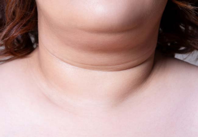 neck fat